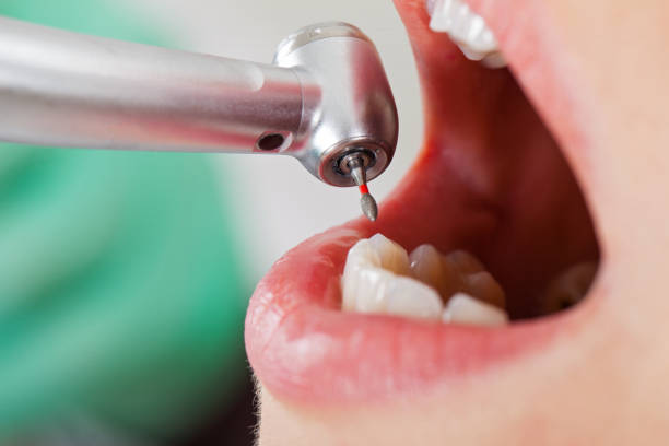 Best Emergency Root Canal Therapy in Waterbury, CT